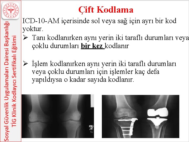 Çift Kodlama ICD-10 -AM içerisinde sol veya sağ için ayrı bir kod yoktur. Ø