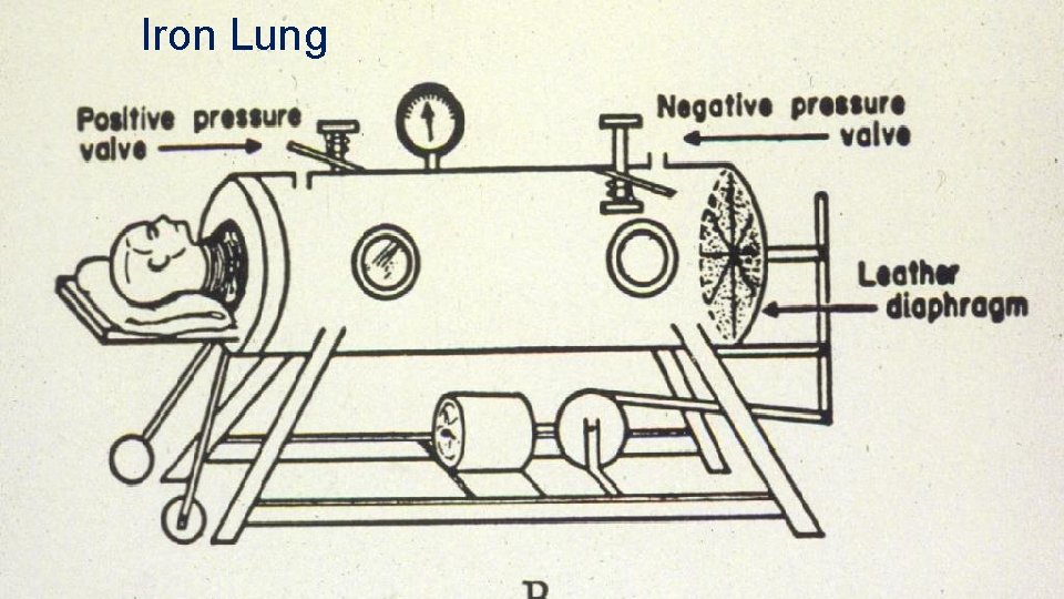 Iron Lung 