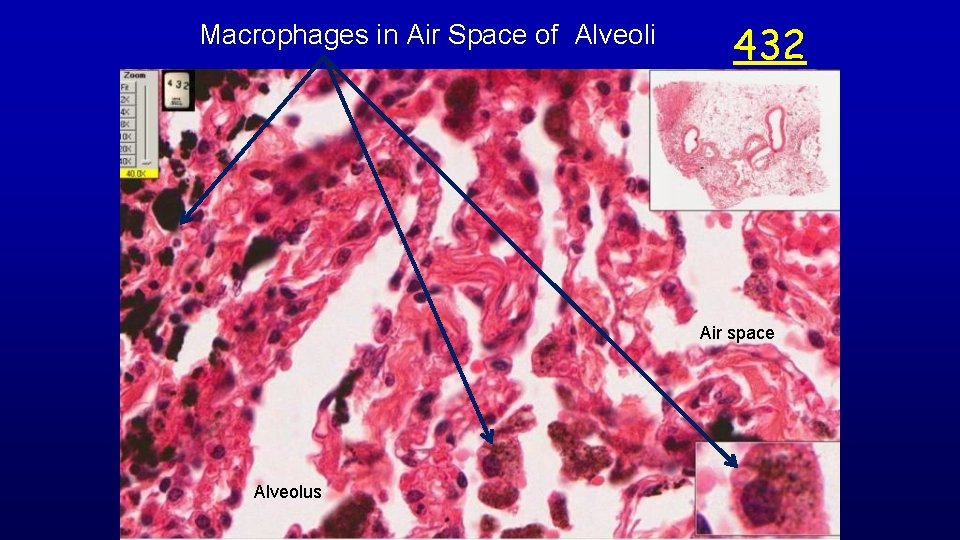 Macrophages in Air Space of Alveoli 432 Air space Alveolus 