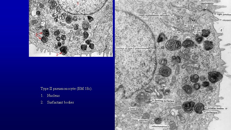 Type II pneumonocyte (EM 18 c). 1. Nucleus 2. Surfactant bodies 