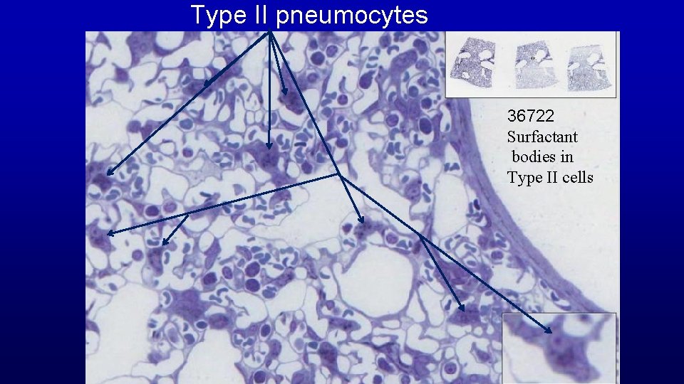 Type II pneumocytes 36722 Surfactant bodies in Type II cells 