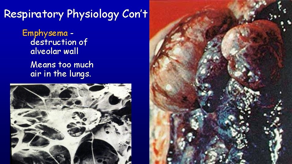 Respiratory Physiology Con’t Emphysema destruction of alveolar wall Means too much air in the