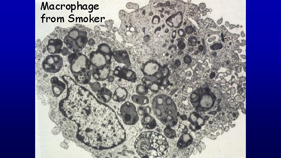 Macrophage from Smoker 