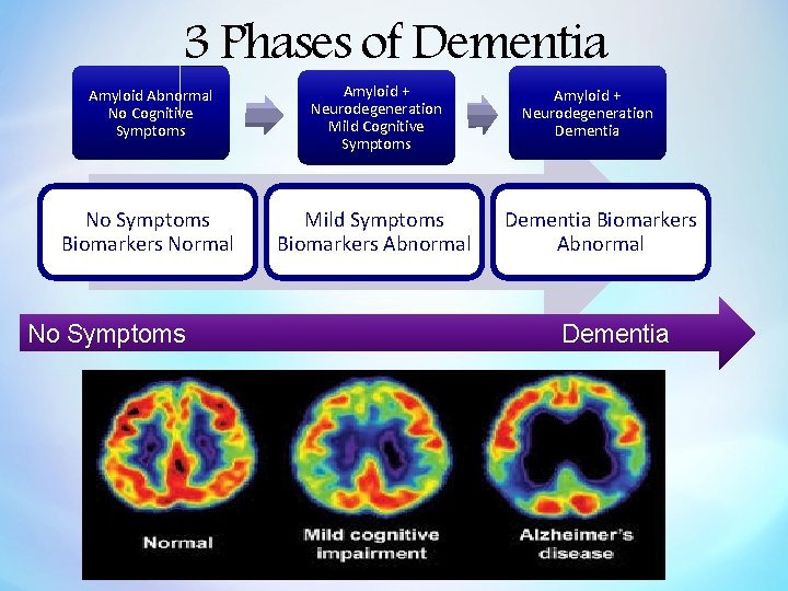 3 Phases of Dementia Amyloid Abnormal No Cognitive Symptoms Amyloid + Neurodegeneration Mild Cognitive