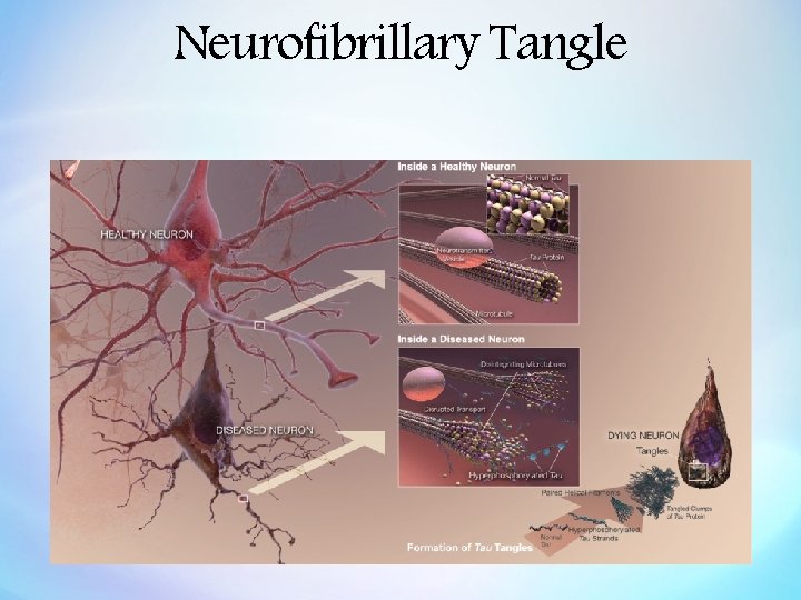Neurofibrillary Tangle 