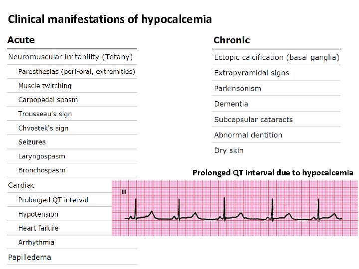 Clinical manifestations of hypocalcemia Prolonged QT interval due to hypocalcemia 