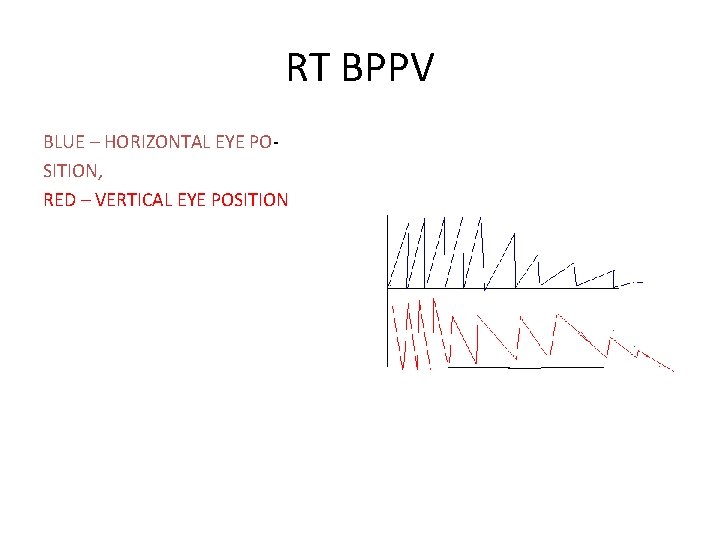 RT BPPV BLUE – HORIZONTAL EYE POSITION, RED – VERTICAL EYE POSITION 