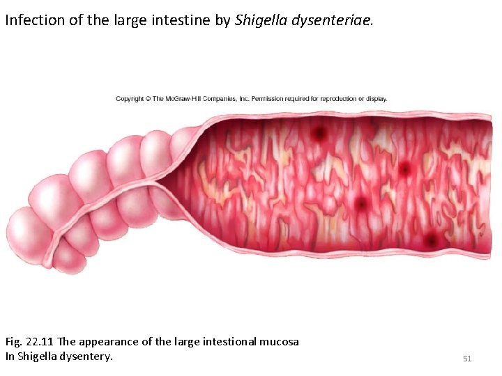 Infection of the large intestine by Shigella dysenteriae. Fig. 22. 11 The appearance of