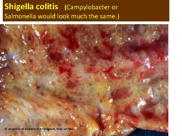 Shigella colitis (Campylobacter or Salmonella would look much the same. ) Salmonella would look