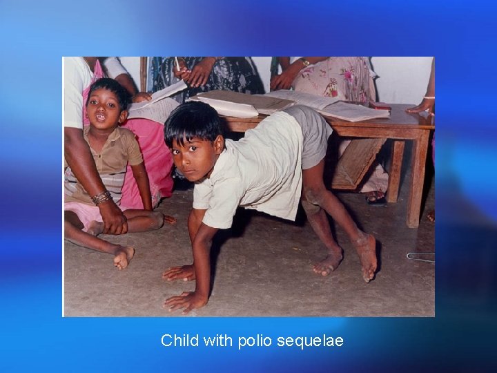 Child with polio sequelae 