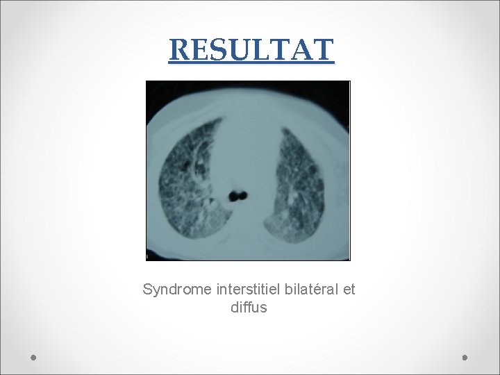 RESULTAT Syndrome interstitiel bilatéral et diffus 