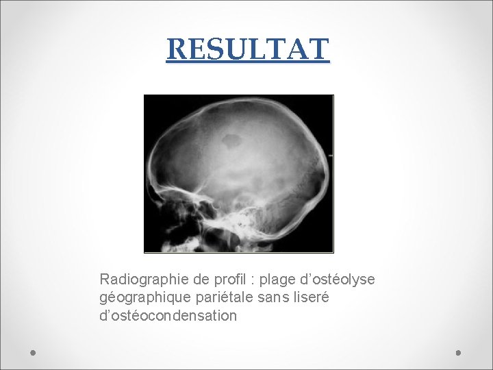 RESULTAT Radiographie de profil : plage d’ostéolyse géographique pariétale sans liseré d’ostéocondensation 