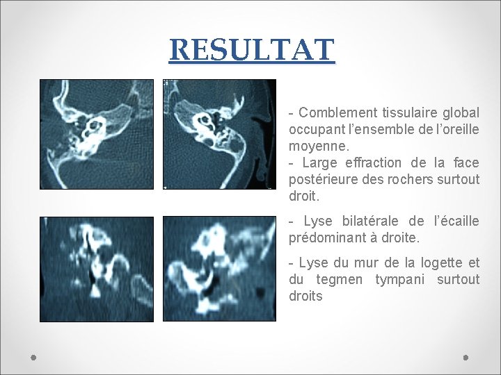 RESULTAT - Comblement tissulaire global occupant l’ensemble de l’oreille moyenne. - Large effraction de