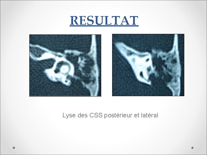 RESULTAT Lyse des CSS postérieur et latéral 