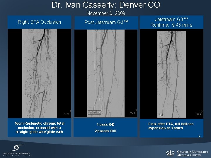 Dr. Ivan Casserly: Denver CO November 6, 2009 Right SFA Occlusion Post Jetstream G