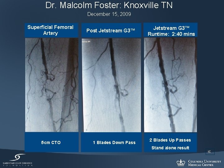 Dr. Malcolm Foster: Knoxville TN December 15, 2009 Superficial Femoral Artery 5 cm CTO