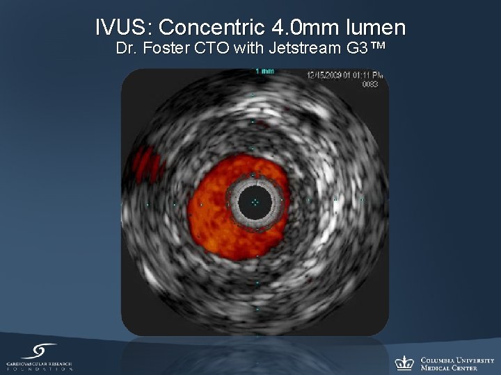 IVUS: Concentric 4. 0 mm lumen Dr. Foster CTO with Jetstream G 3™ 