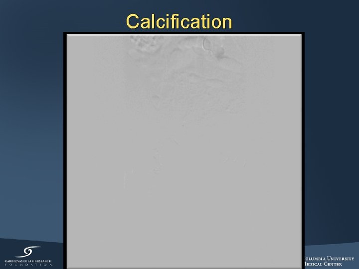 Calcification 