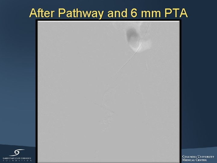 After Pathway and 6 mm PTA 