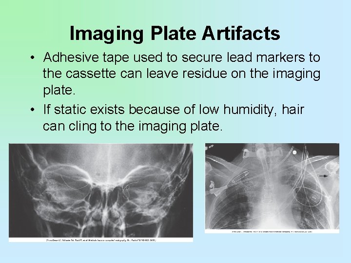 Imaging Plate Artifacts • Adhesive tape used to secure lead markers to the cassette