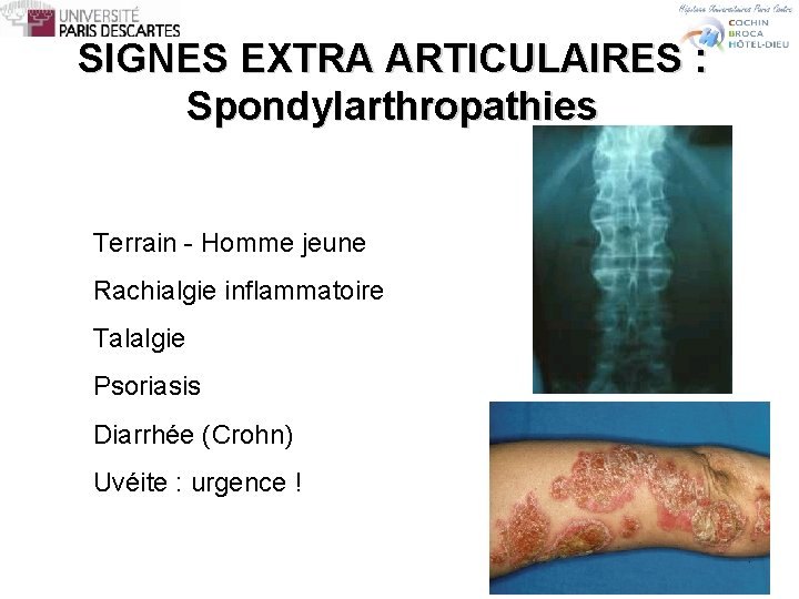 SIGNES EXTRA ARTICULAIRES : Spondylarthropathies Terrain - Homme jeune Rachialgie inflammatoire Talalgie Psoriasis Diarrhée