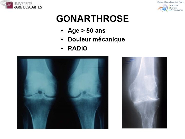 GONARTHROSE • Age > 50 ans • Douleur mécanique • RADIO 