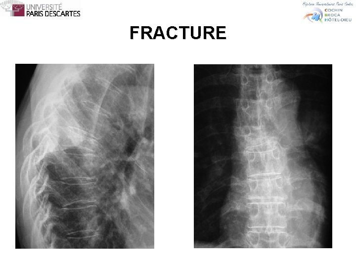 FRACTURE 