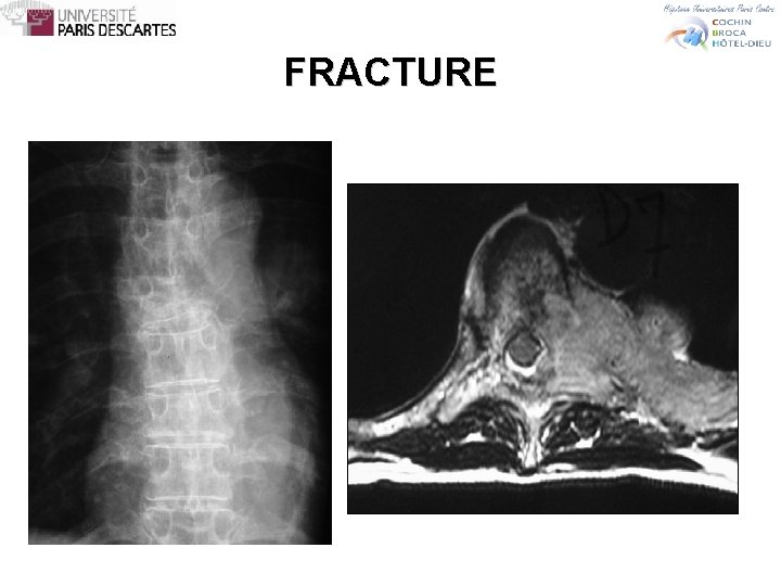 FRACTURE 