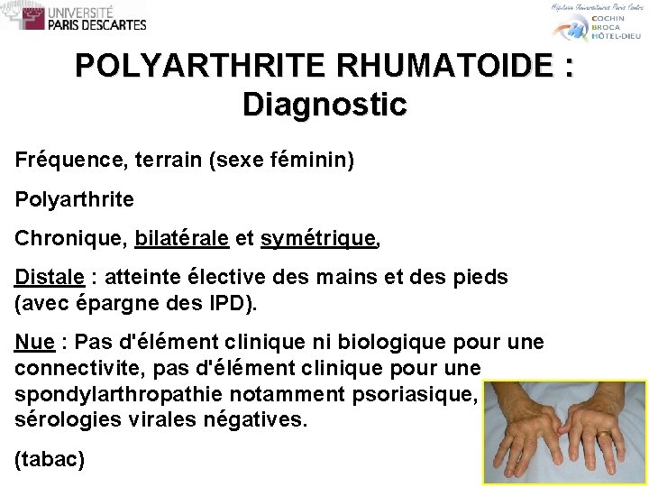 POLYARTHRITE RHUMATOIDE : Diagnostic Fréquence, terrain (sexe féminin) Polyarthrite Chronique, bilatérale et symétrique, Distale