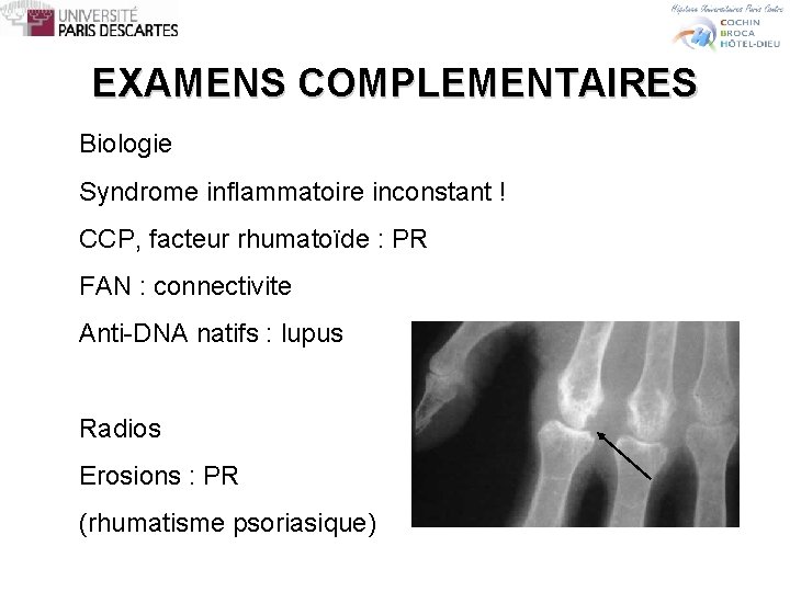 EXAMENS COMPLEMENTAIRES Biologie Syndrome inflammatoire inconstant ! CCP, facteur rhumatoïde : PR FAN :