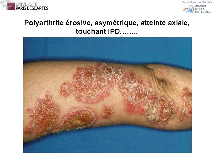 Polyarthrite érosive, asymétrique, atteinte axiale, touchant IPD……. . 