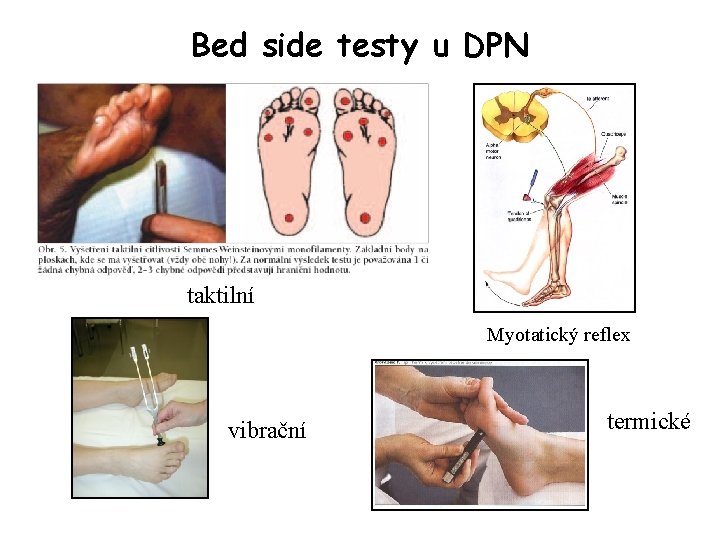 Bed side testy u DPN taktilní Myotatický reflex vibrační termické 