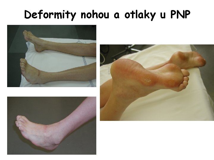 Deformity nohou a otlaky u PNP 