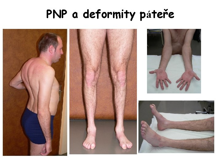 PNP a deformity páteře 