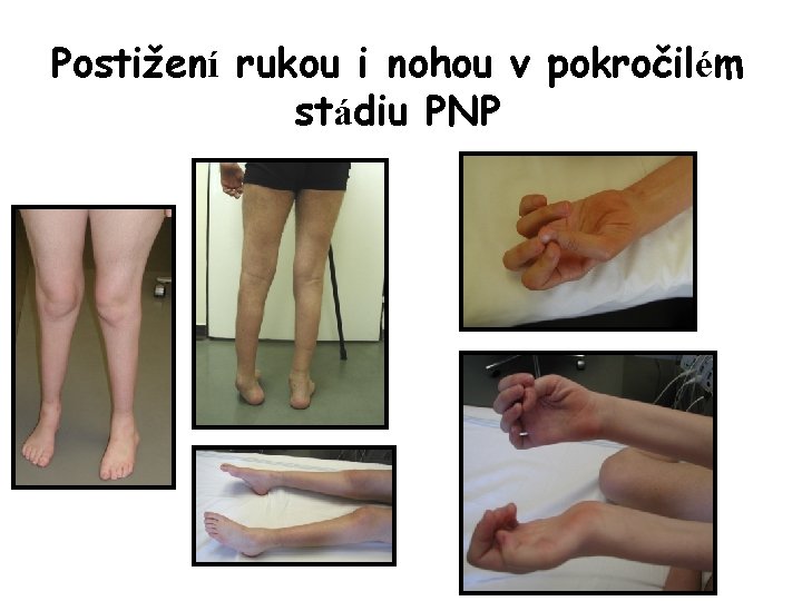 Postižení rukou i nohou v pokročilém stádiu PNP 