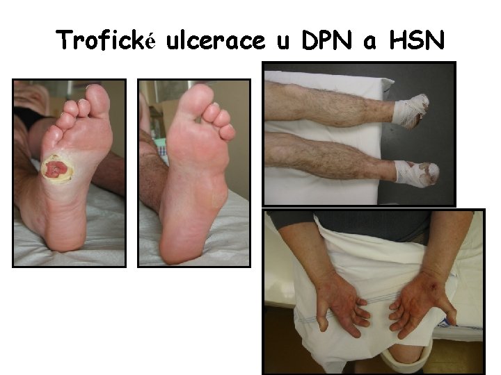 Trofické ulcerace u DPN a HSN 
