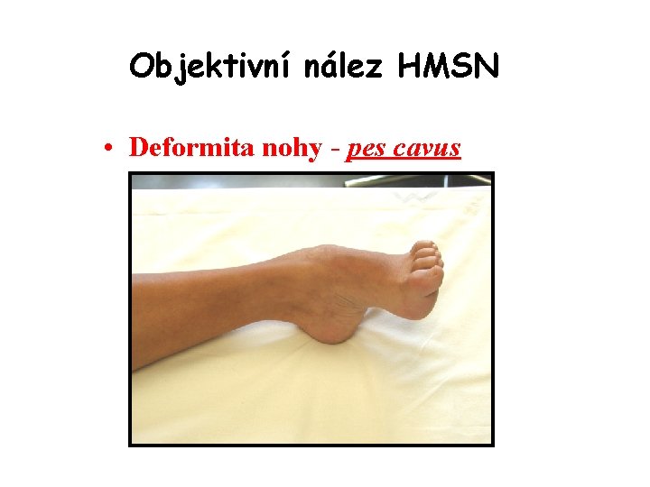 Objektivní nález HMSN • Deformita nohy - pes cavus 