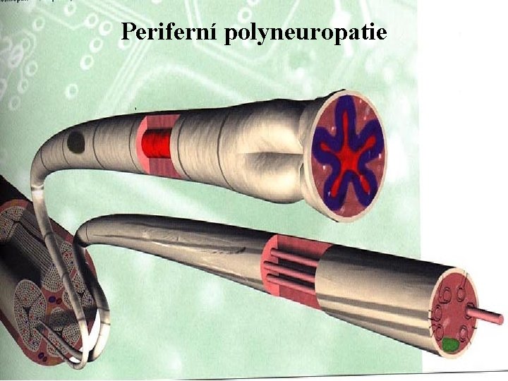 Periferní polyneuropatie 