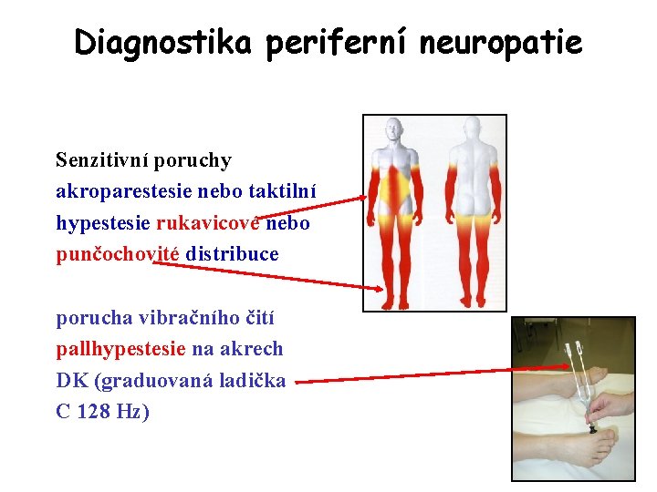 Diagnostika periferní neuropatie Senzitivní poruchy akroparestesie nebo taktilní hypestesie rukavicové nebo punčochovité distribuce porucha