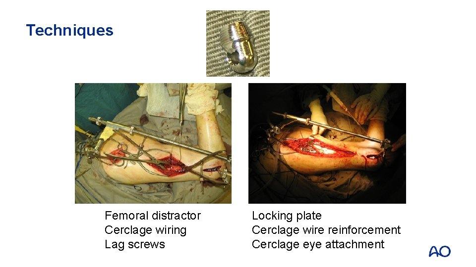 Techniques Femoral distractor Cerclage wiring Lag screws Locking plate Cerclage wire reinforcement Cerclage eye