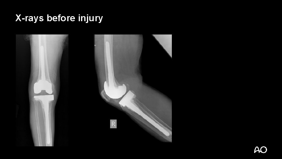 X-rays before injury 