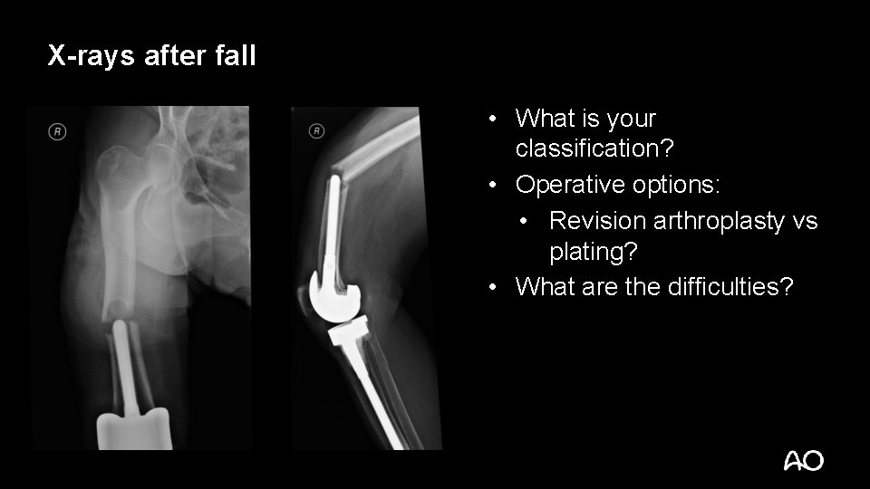 X-rays after fall • What is your classification? • Operative options: • Revision arthroplasty