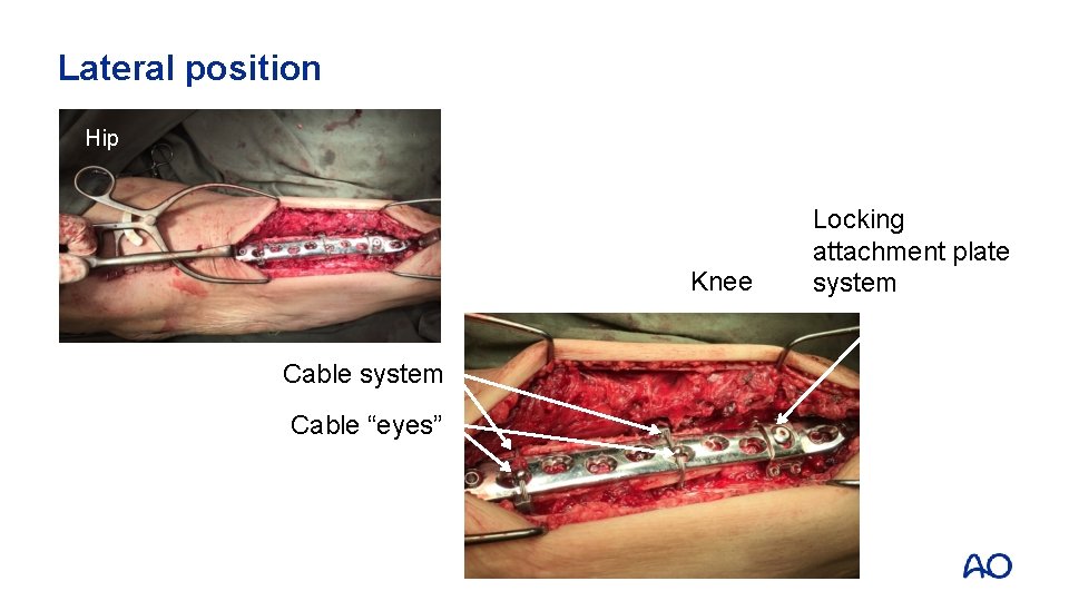 Lateral position Hip Knee Cable system Cable “eyes” Locking attachment plate system 