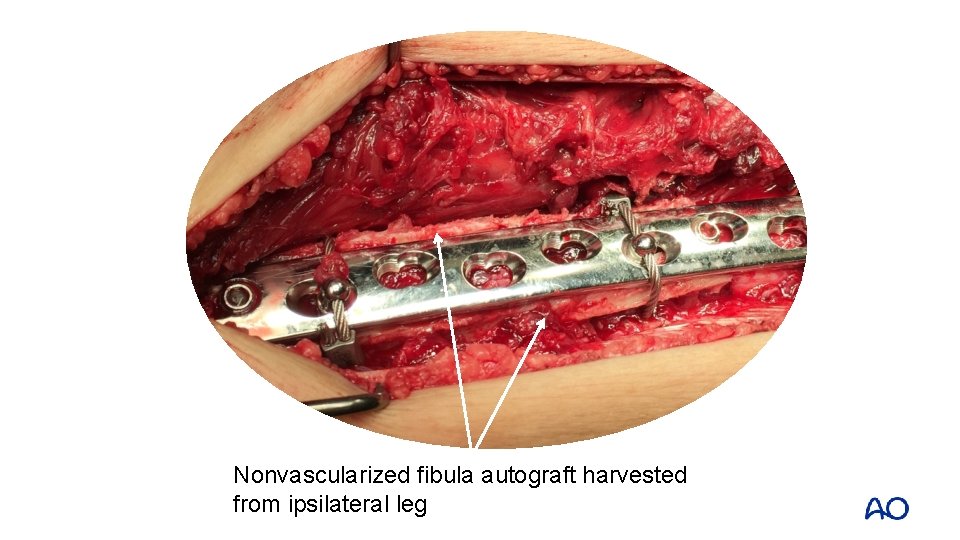 Nonvascularized fibula autograft harvested from ipsilateral leg 