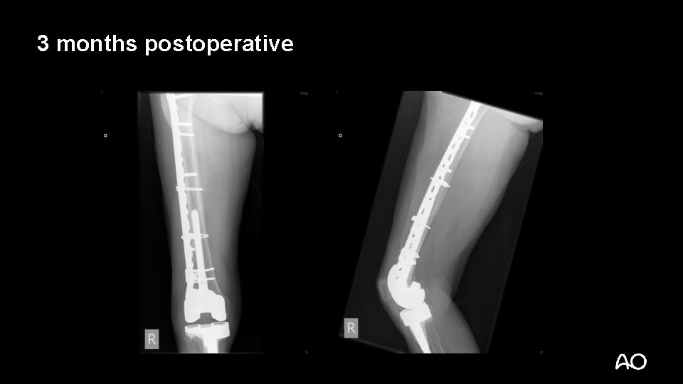 3 months postoperative 