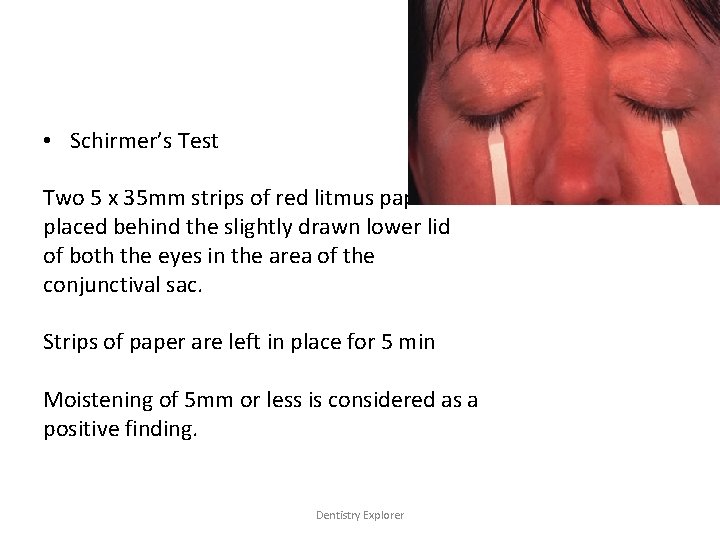  • Schirmer’s Test Two 5 x 35 mm strips of red litmus paper