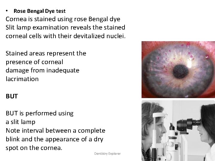  • Rose Bengal Dye test Cornea is stained using rose Bengal dye Slit