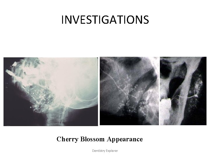 INVESTIGATIONS Cherry Blossom Appearance Dentistry Explorer 