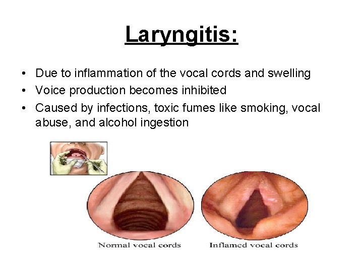 Laryngitis: • Due to inflammation of the vocal cords and swelling • Voice production