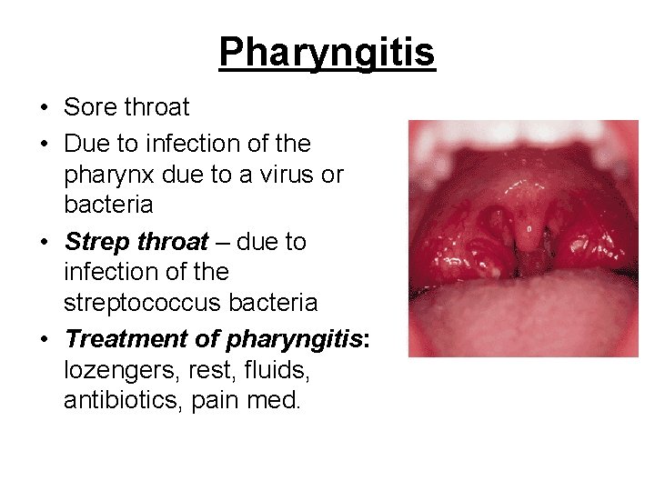 Pharyngitis • Sore throat • Due to infection of the pharynx due to a